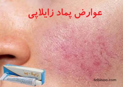 عوارض کرم زایلاپی